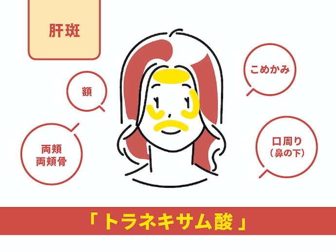 肝斑に悩む30～40代女性には、「トラネキサム酸」